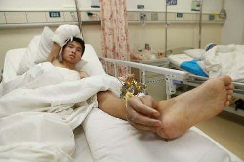 Man lost hands in accident doctor grafted it on leg