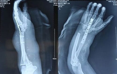 Man lost hands in accident doctor grafted it on leg