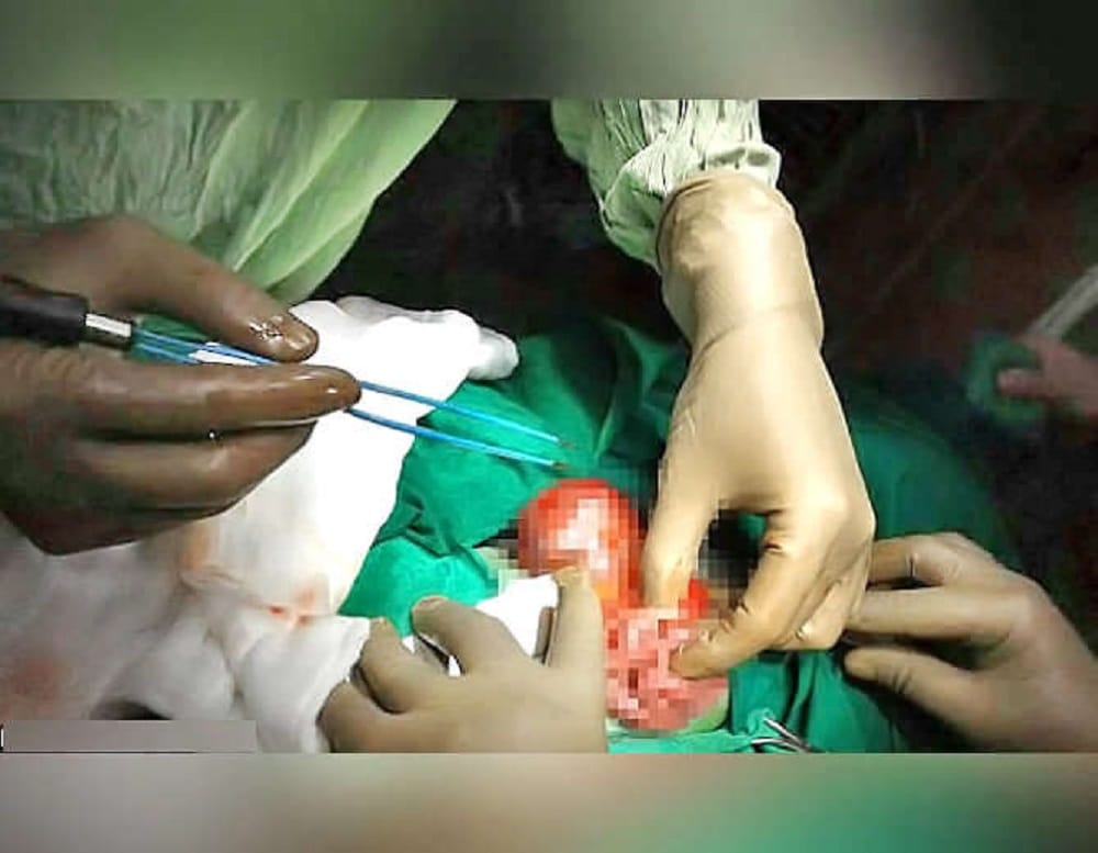 Bizarre incidence of pregnant baby born carrying his twin brother in foetus in   Mumbai