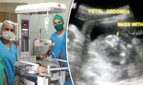 Bizarre incidence of pregnant baby born carrying his twin brother in foetus in   Mumbai
