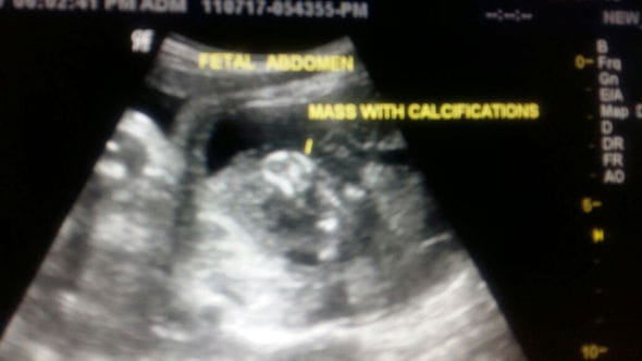 Bizarre incidence of pregnant baby born carrying his twin brother in foetus in   Mumbai