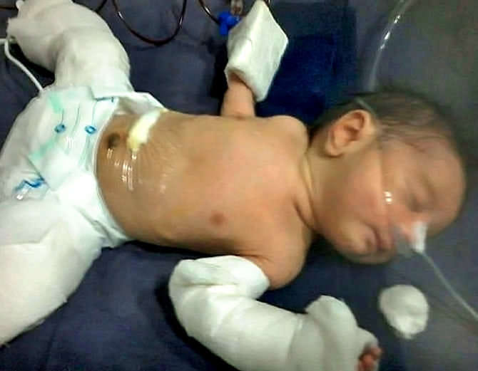 Bizarre incidence of pregnant baby born carrying his twin brother in foetus in   Mumbai
