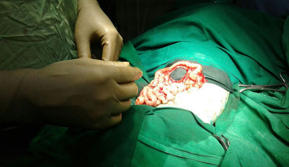 Bizarre incidence of pregnant baby born carrying his twin brother in foetus in   Mumbai