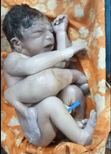 Successful operation of strange child