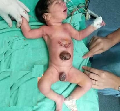 Successful operation of strange child