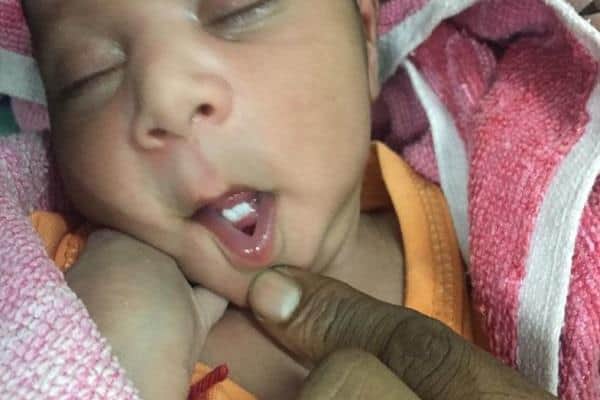 miracal of god, teeth in 16 days girl child mouth