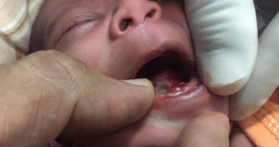 miracal of god, teeth in 16 days girl child mouth