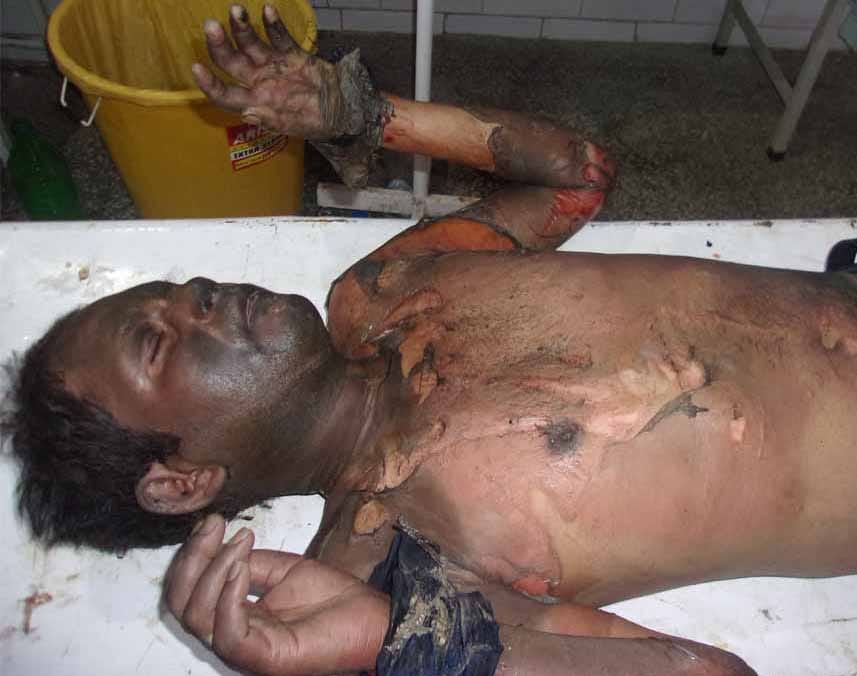 Youth burnt in laws