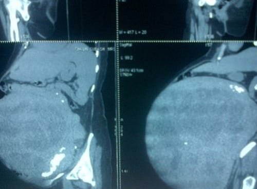 32 kilogram tumour removed from women abdomen after   years in Guatemala in Central America