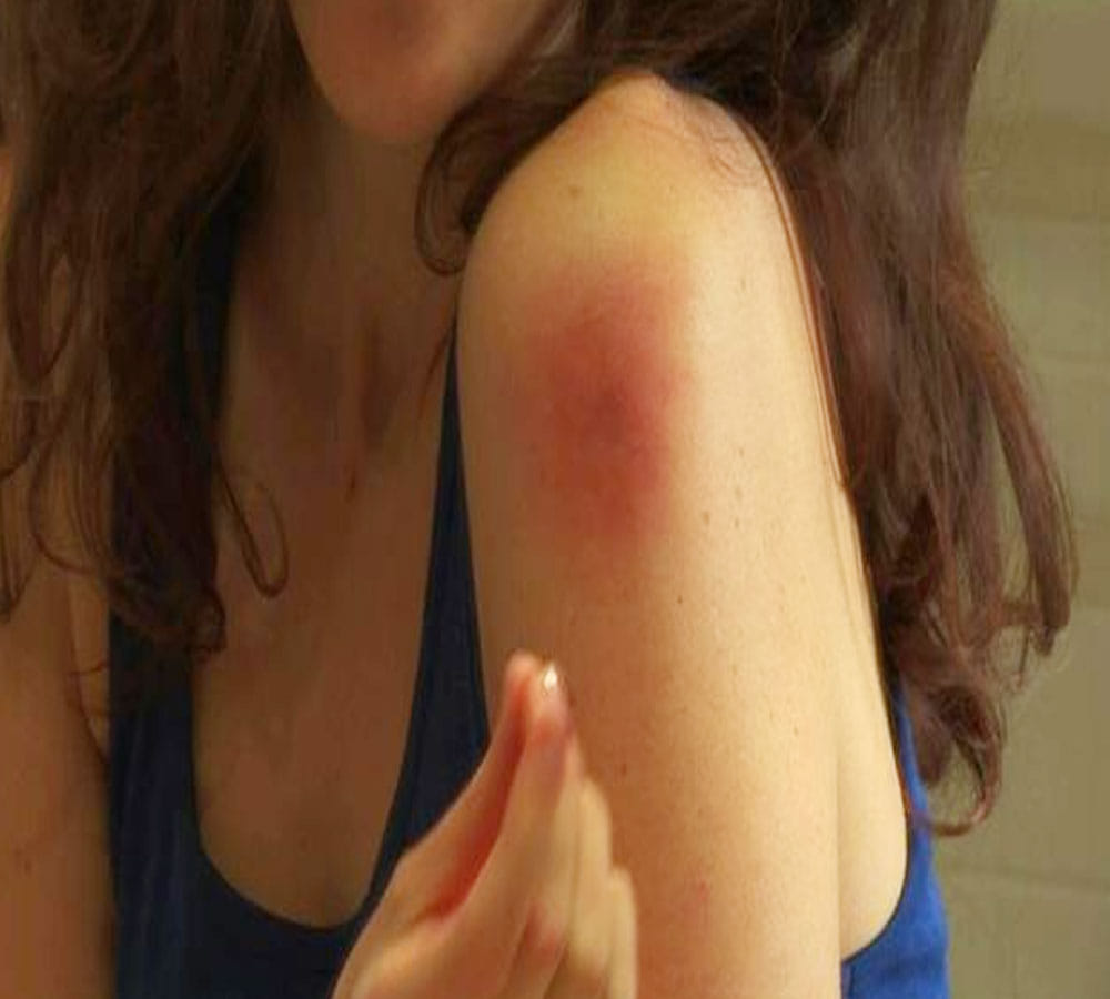 home remedy for honey bee bite swelling