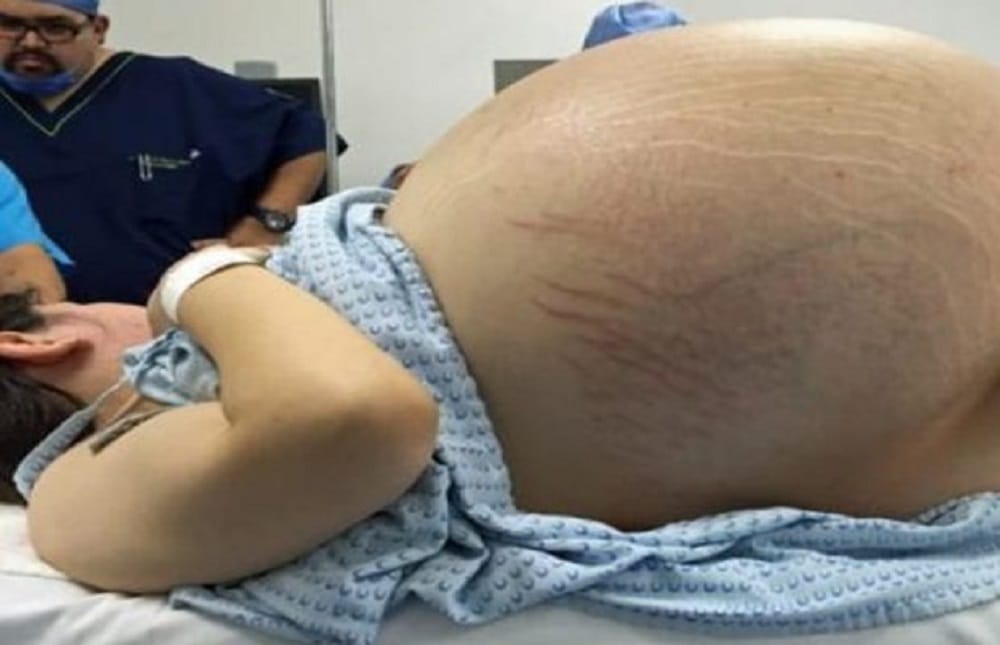 32 kilogram tumour removed from women abdomen after   years in Guatemala in Central America