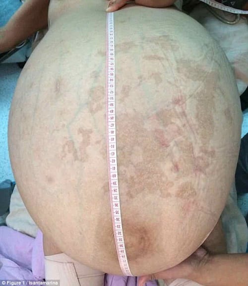 32 kilogram tumour removed from women abdomen after   years in Guatemala in Central America