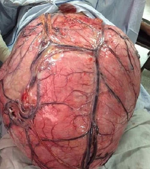 32 kilogram tumour removed from women abdomen after   years in Guatemala in Central America