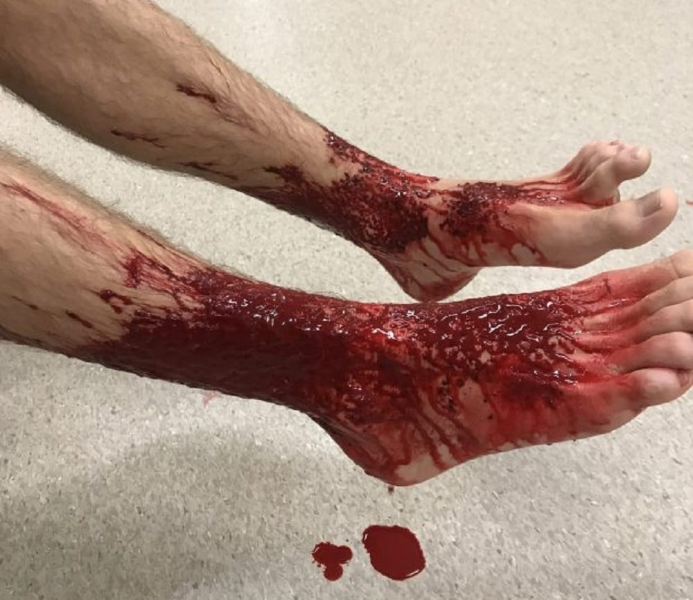 Bug Eat Teenager feet while Strolling Sea beach at Brighton in Melbourne