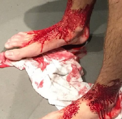 Bug Eat Teenager feet while Strolling Sea beach at Brighton in Melbourne