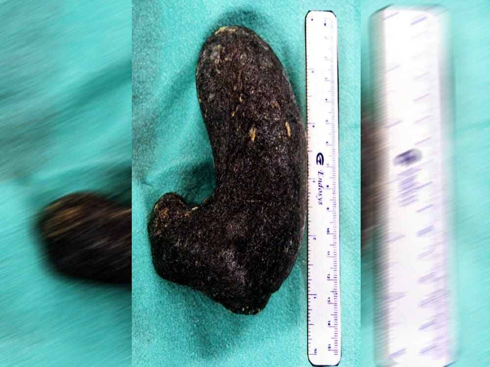  doctors found hairs bunch in girl stomach during operation in dehradun
