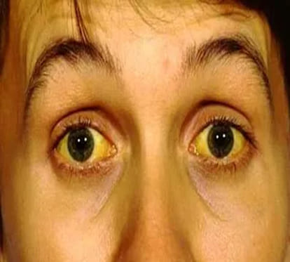 150 cases of jaundice in Himachal pradesh polluted water is reason