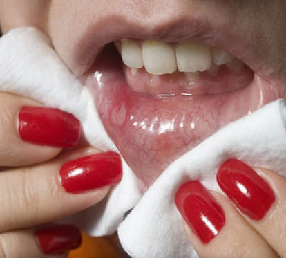 Amazing homemade treatment for mouth ulcer