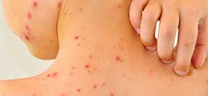 Kerala witnessing surge in chickenpox cases know symptoms and prevention tips in hindi