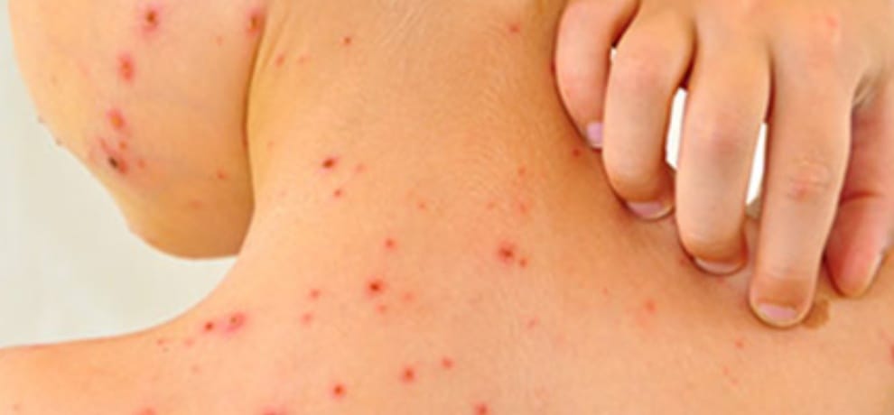 Mumbai worst-affected from Measles, 717 cases found in Maharashtra