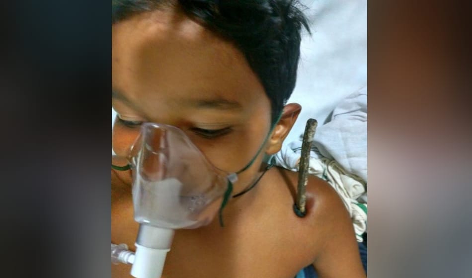 iron rod penetrate into 8th class student shoulder in greater noida