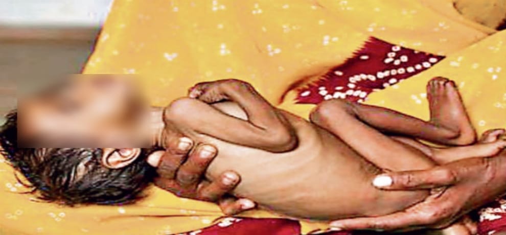 कुपोषण से निपटने में अधिकारी और कर्मचारी गंभीरता  बरतें