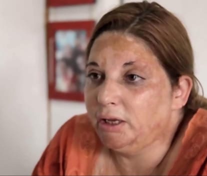 a woman suffered by her boyfriend, poured insecticide over her and set her on fire 