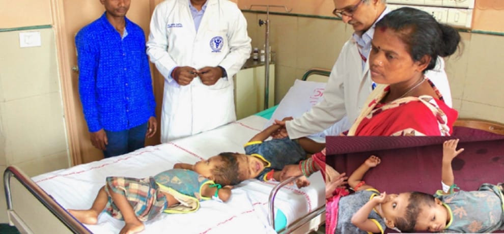first round of surgery of twins attached with head successful in aiims delhi, it took 24 hours