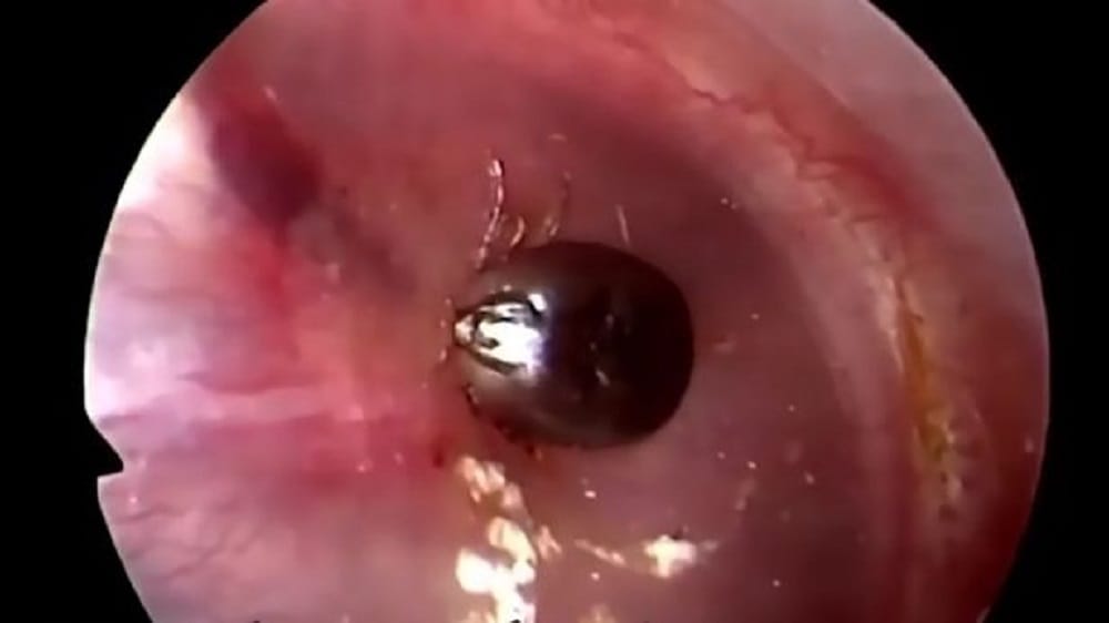 Watch how parasite was removed from man ear