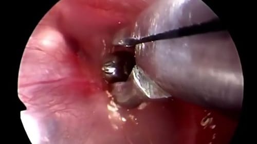 Watch how parasite was removed from man ear