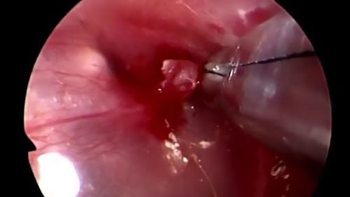 Watch how parasite was removed from man ear