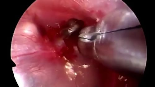 Watch how parasite was removed from man ear