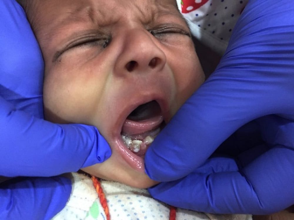 Baby born with seven teeth at Ahmedabad in Gujarat 