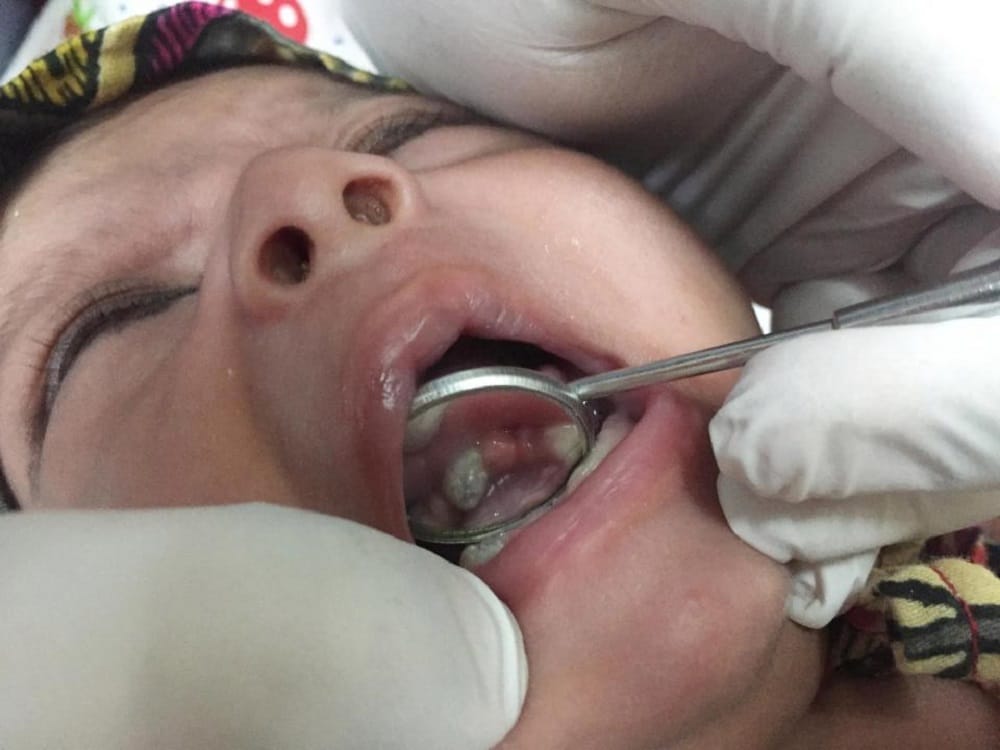 Baby born with seven teeth at Ahmedabad in Gujarat 