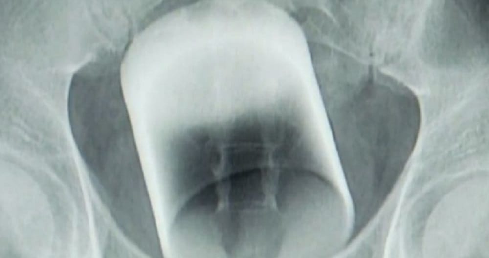 Glass Cup found inside man body in china