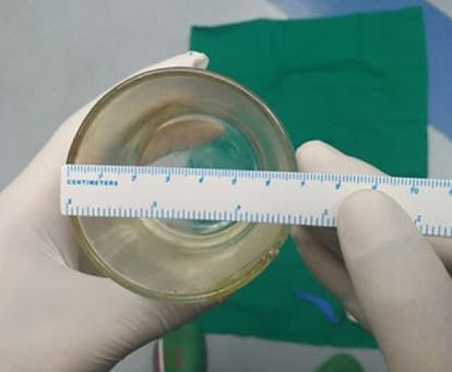 Glass Cup found inside man body in china