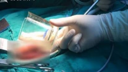 Glass Cup found inside man body in china