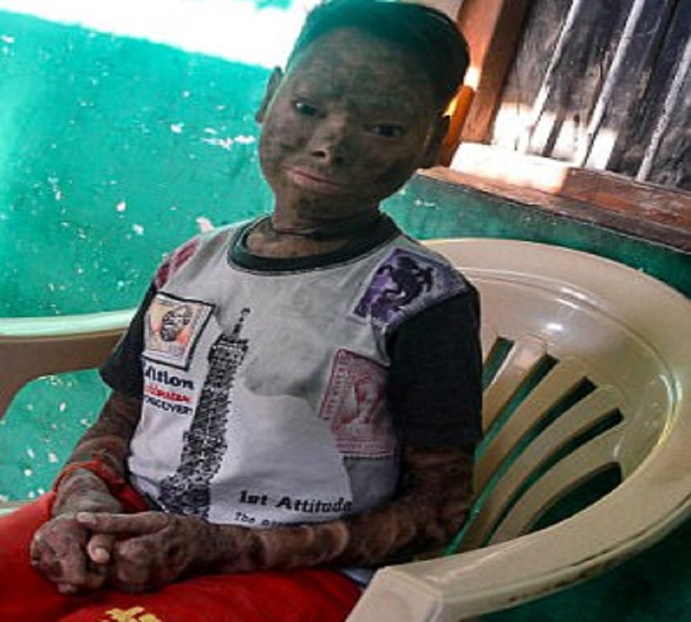 mp girl become sanke girl due to Erythroderma