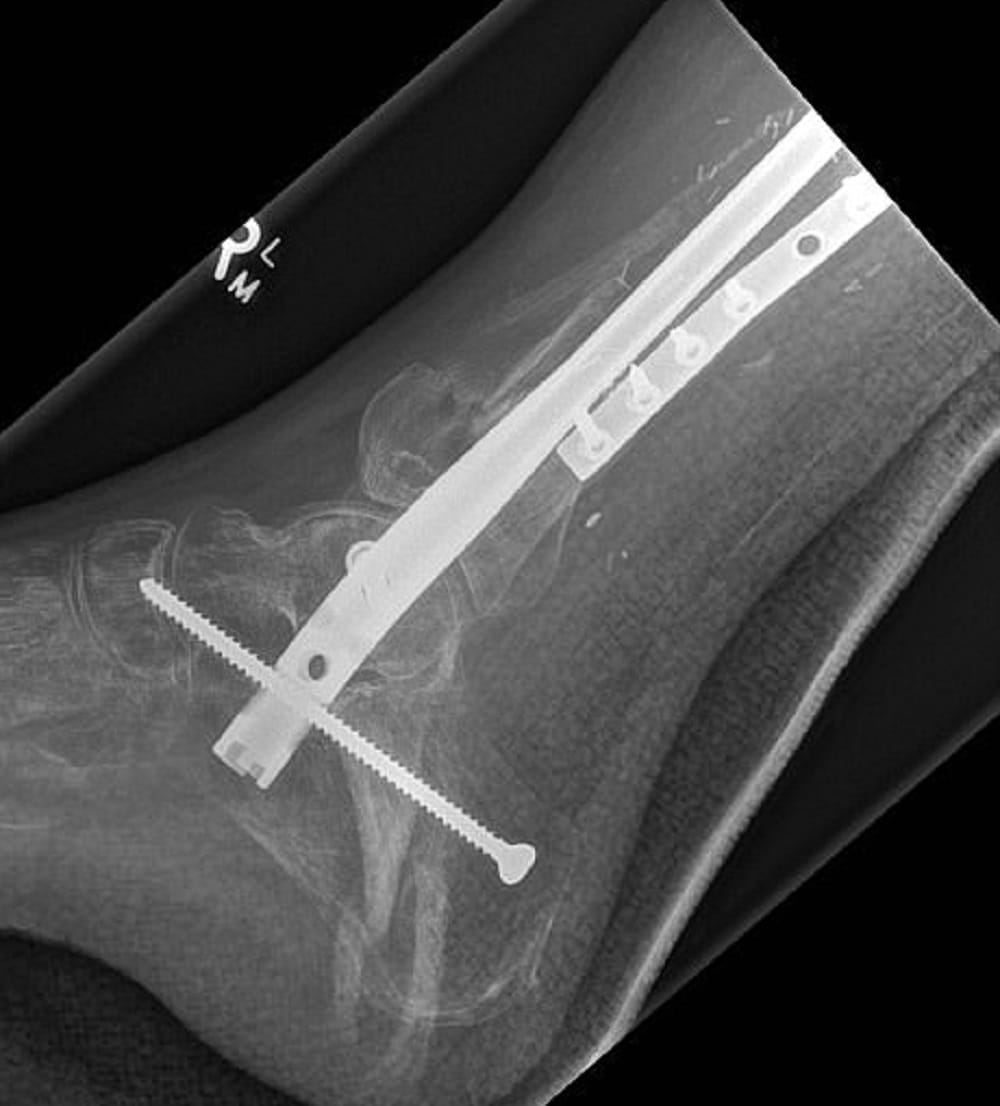 Human Bones made by 3 D Printer for the first time in World