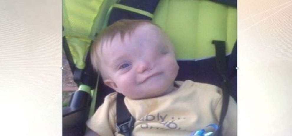 Instagram removed the picture of the child without a eye