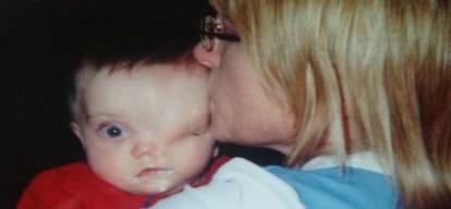 Instagram removed the picture of the child without a eye