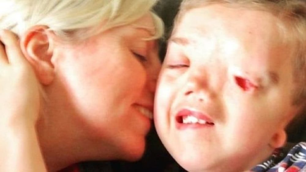 Instagram criticized for removing picture of child who has only one eye