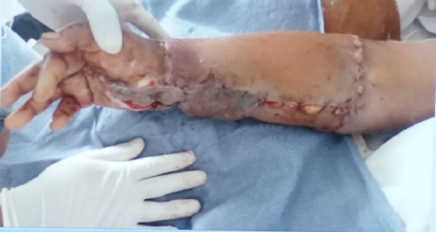 doctors do surgery for reunite woman cut hand again in haldwani