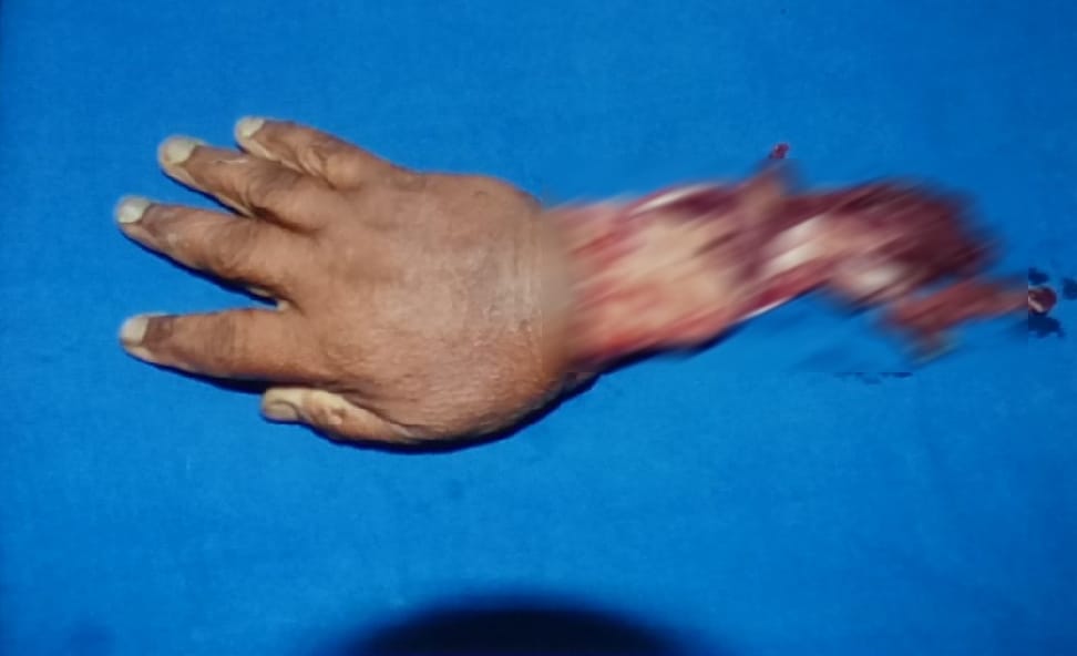 doctors do surgery for reunite woman cut hand again in haldwani