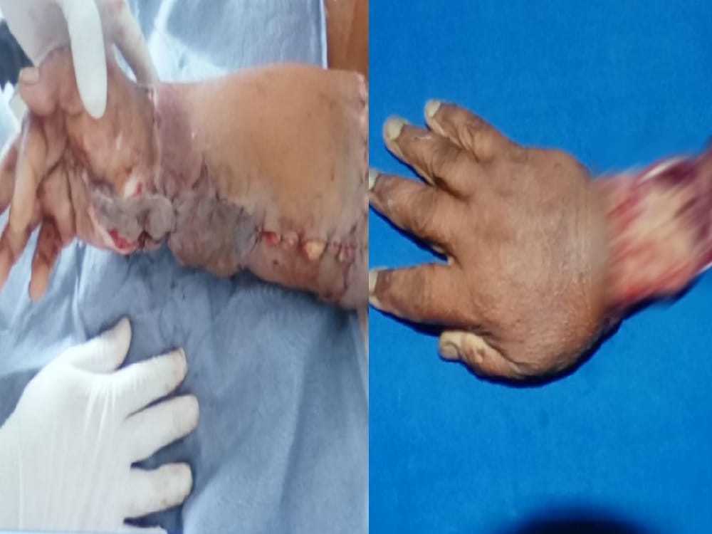 doctors do surgery for reunite woman cut hand again in haldwani