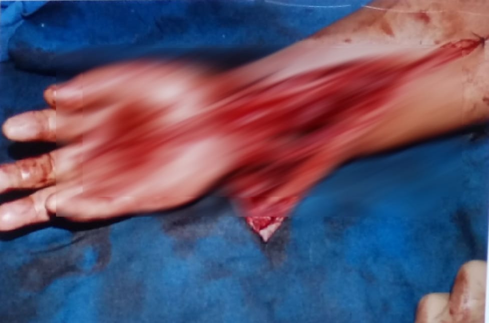 doctors do surgery for reunite woman cut hand again in haldwani