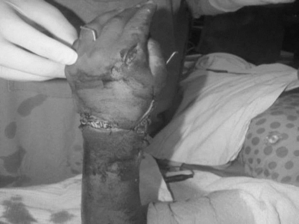 doctors do surgery for reunite woman cut hand again in haldwani