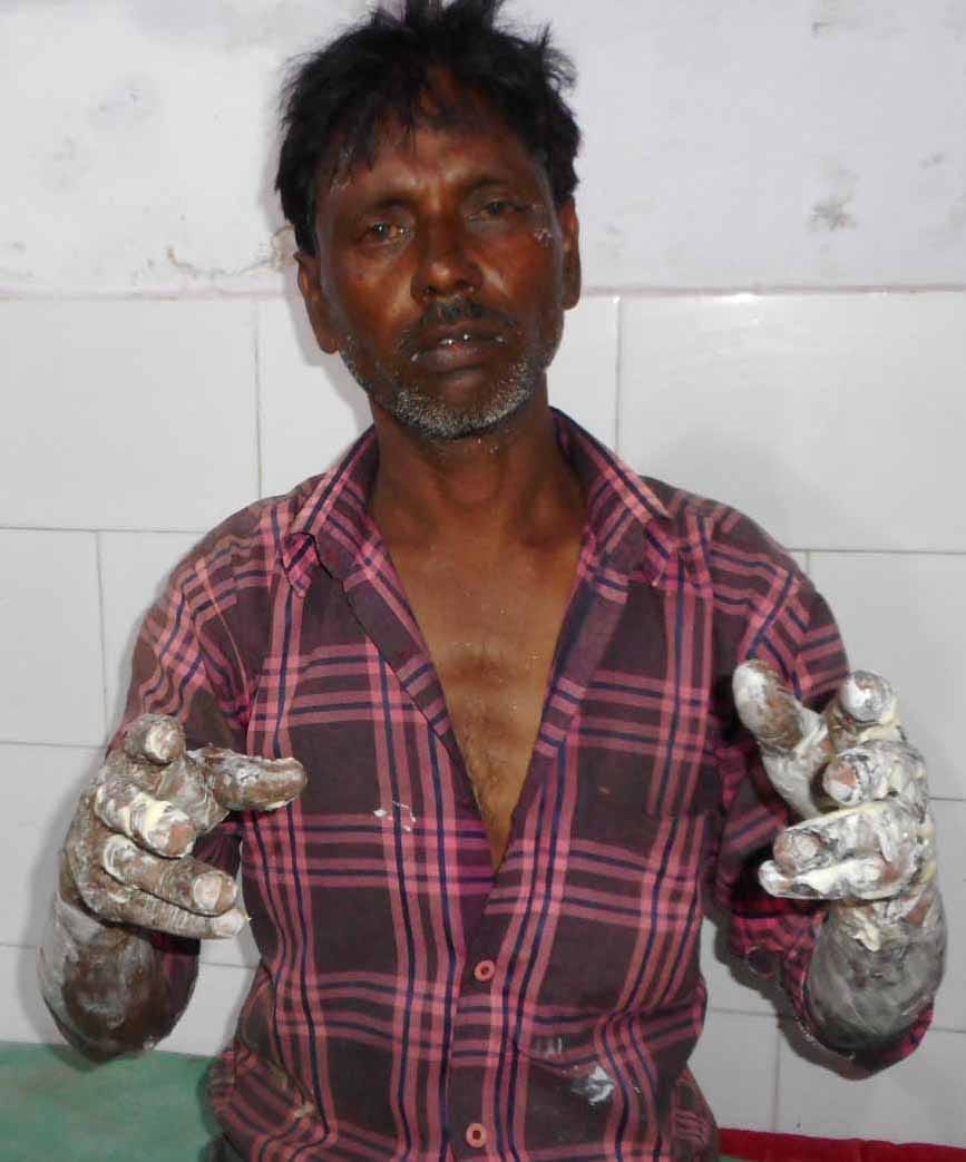Man burnt while saving woman