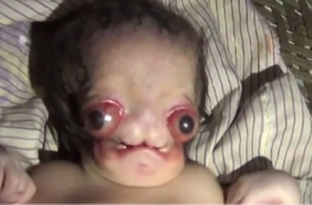 Baby born with facial deformities at Aligarh in Uttar Pradesh