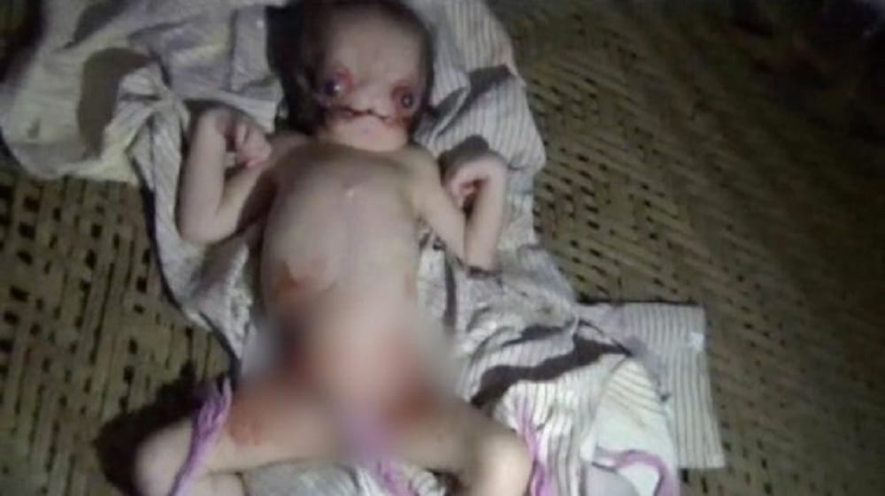 Baby born with facial deformities at Aligarh in Uttar Pradesh